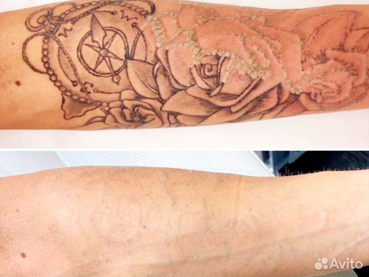 Удаление татуировок и татуажа