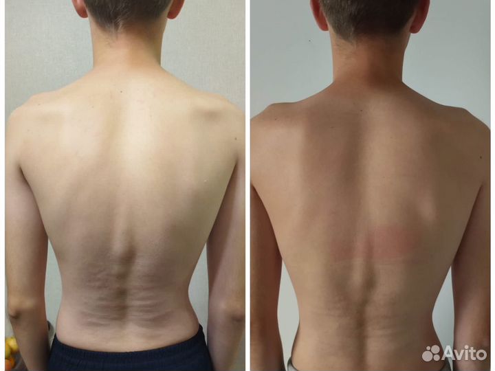 Массаж Остеопластика (остеопатический)