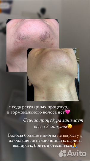 Модели на электроэпиляцию