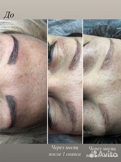 Лазерное удаление татуажа, тату