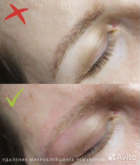 Удаление татуажа лазером, ремувером