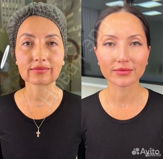 Минус 15 лет за 1 процедуру. Альтератерапия