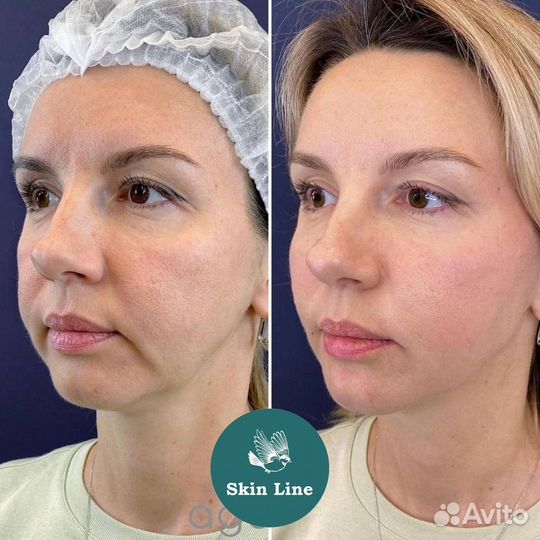 Фракционная мезотерапия/ дермапен премиум составы