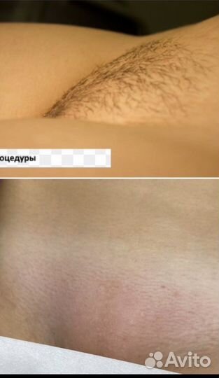 Шугаринг: руки выше локтя