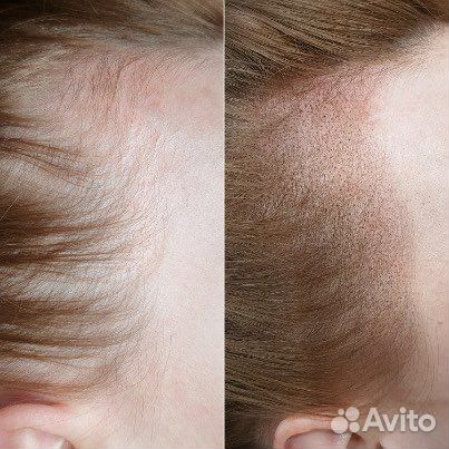 Трихопигментация женская загущение волос