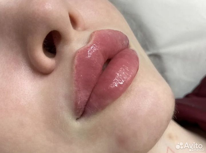 Увеличение губ