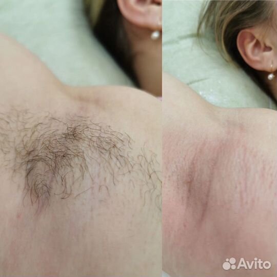 Депиляция - сахар/ воск. кмр