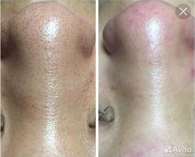 Карбоновый пилинг аппарат