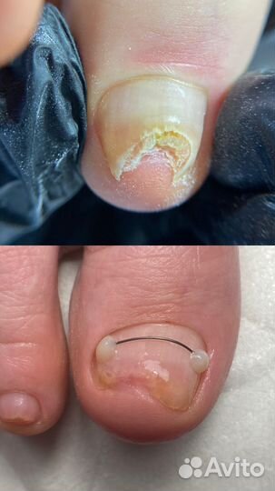 Педикюр подолог