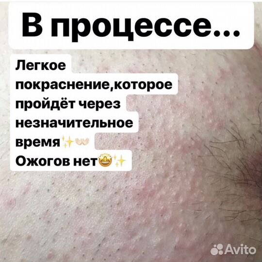 Электроэпиляция женская