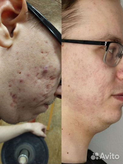 Косметолог чистка лица