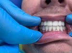 Зубные протезы Ремонт зубных протезов