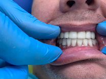 Зубные протезы Ремонт зубных протезов
