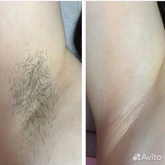 Депиляция воск шугаринг