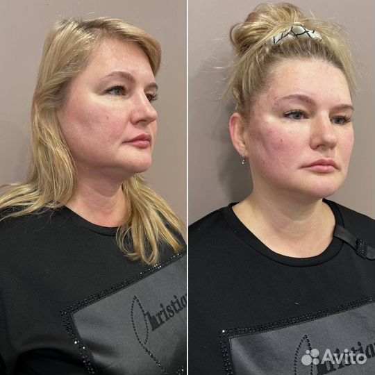 Нитевой лифтинг лица