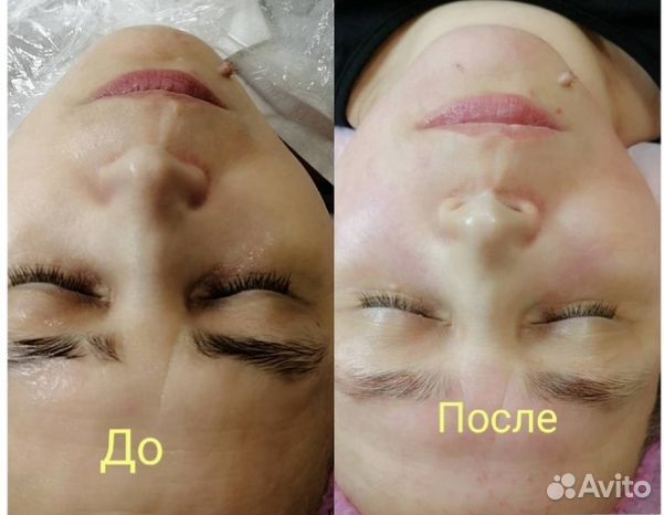 Хиджама обучение