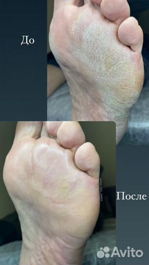 Подолог - Smart-педикюр ангарск