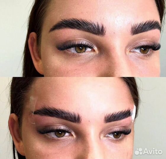 Красивый лифтинг бровей (нити, ботокс)