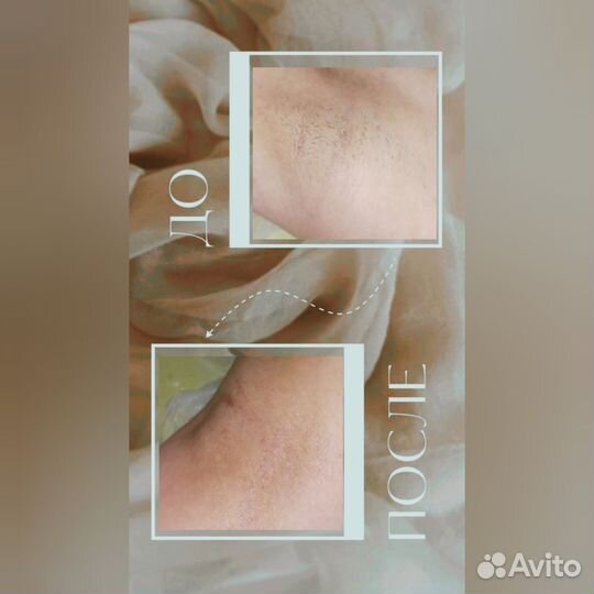 Шугаринг и восковая депиляция