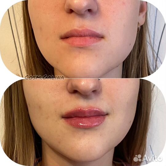 Увеличение губ, ботокс