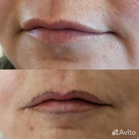 Удаление татуажа лазером