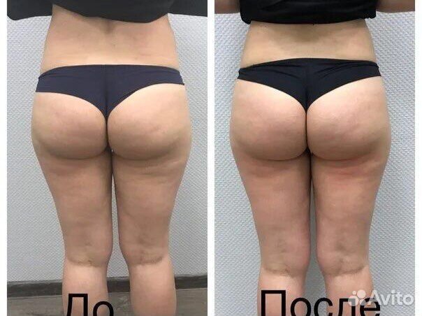 Аппаратный массаж, LPG, Vela Shape, Лаз. Эпиляция