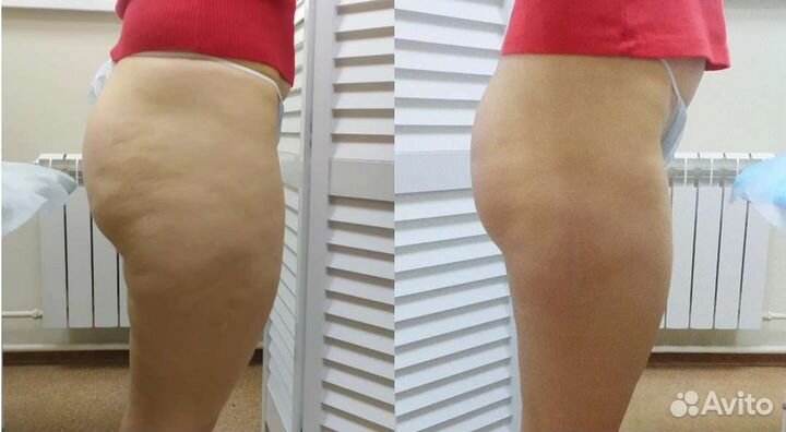 LPG, массаж тела и лица, коррекция фигуры