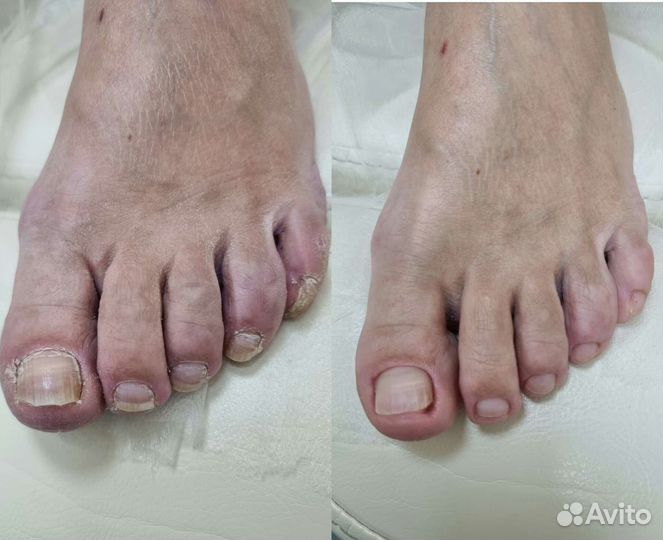 Медицинский педикюр подолог