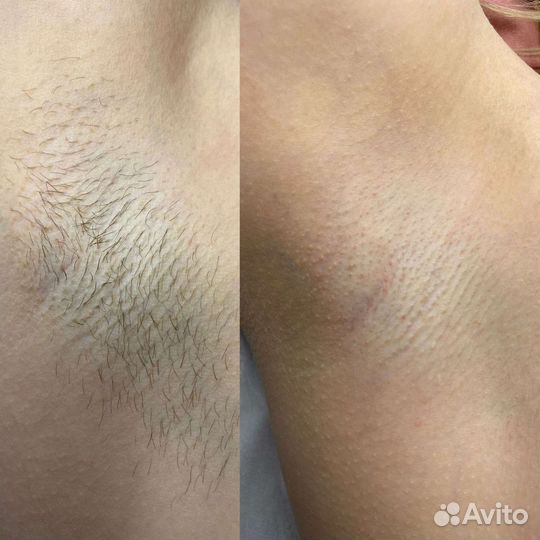 Шугаринг сахарное моделирование