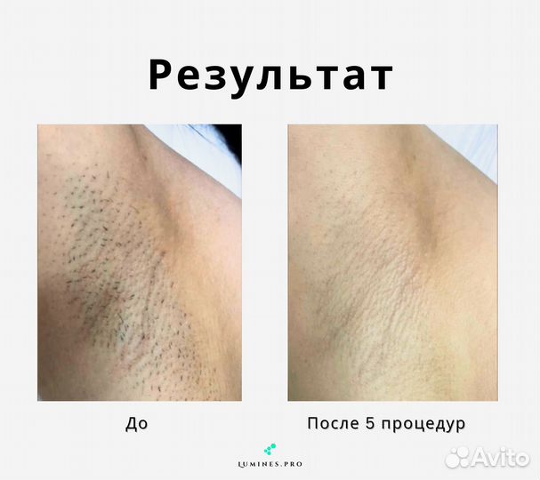 Диодный лазер Лю’минес Max One 1200в