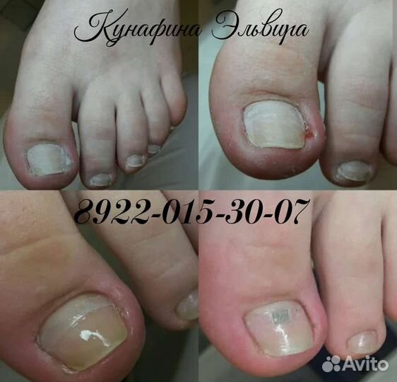Маникюр, педикюр,с вросшими,деформ-ными,ногтями