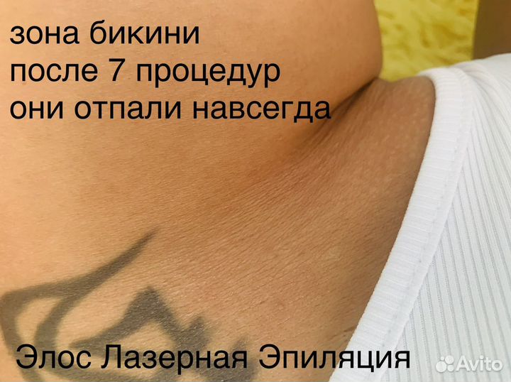 Лазерная Элос Эпиляция