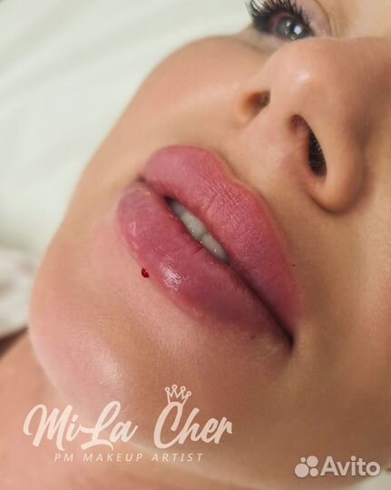 Увеличение губ