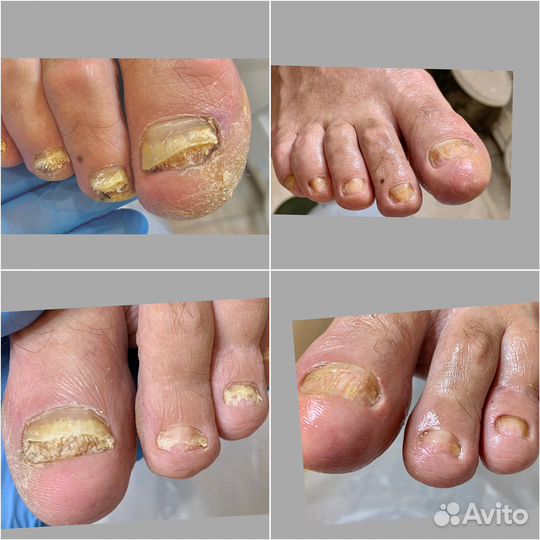 Педикюр,подолог,вросшие ногти