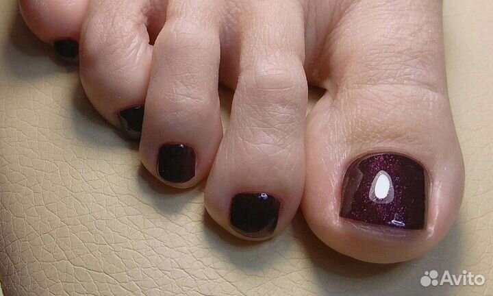 Коррекция вросшего ногтя