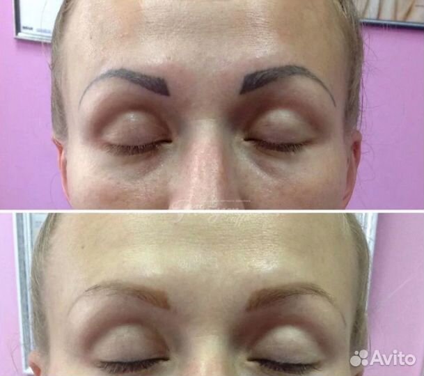 Удаление татуировок лазером