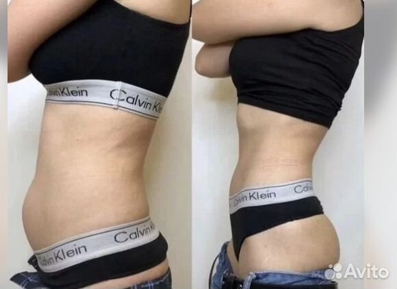 Криолиполиз