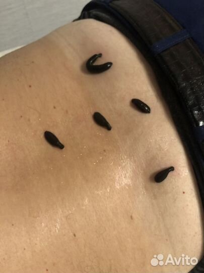 Сертификат на гирудотерапию