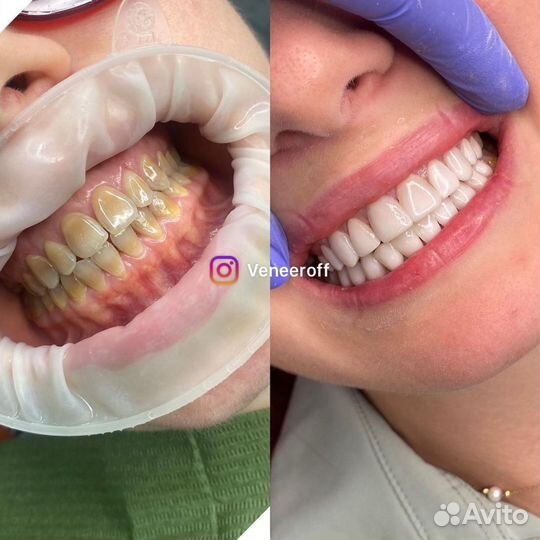 Виниры художественные