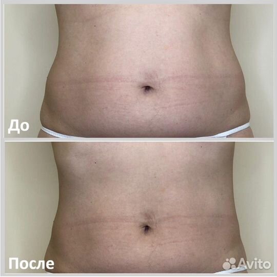 LPG (5 сеансов вакуумного массажа для позулкния)