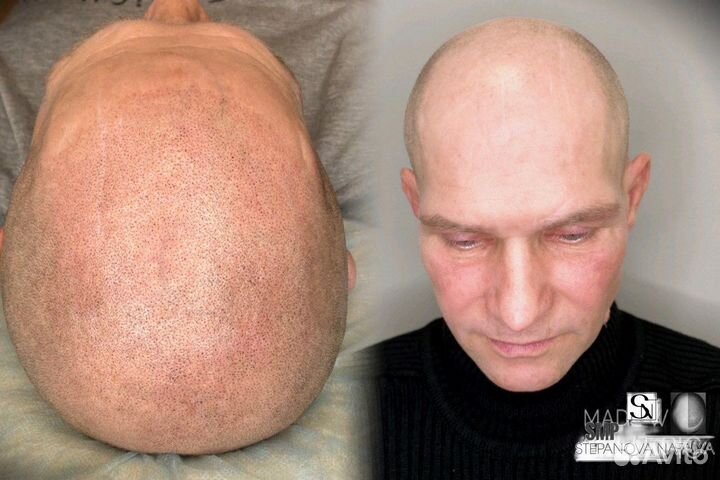 Трихопигментация SMP