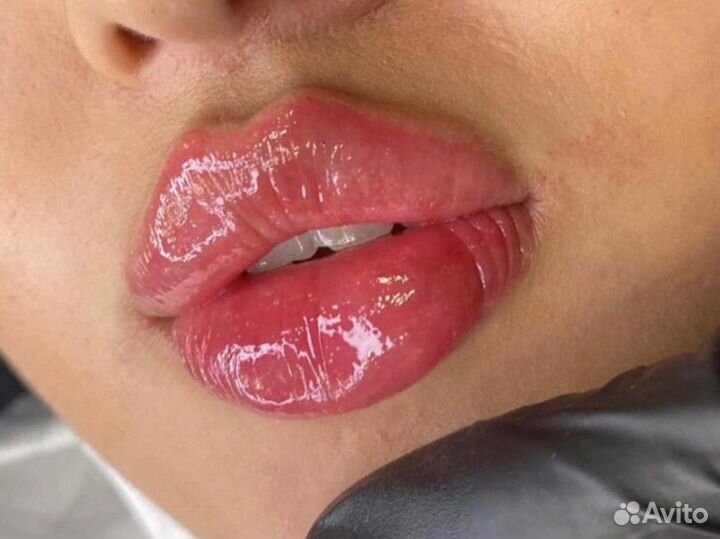 Губы /подбородок /ботокс/скулы