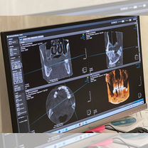 Имплантация зубов. Корейские импланты Osstem, Омск
