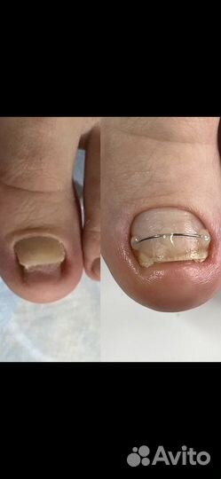 Медицинский педикюр