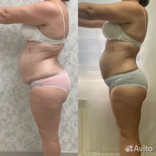 LPG, прессотерапия