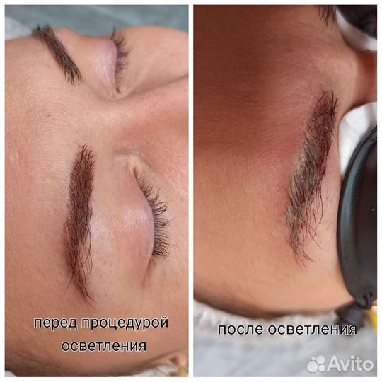 Осветление и удаление татуажа и татуировок