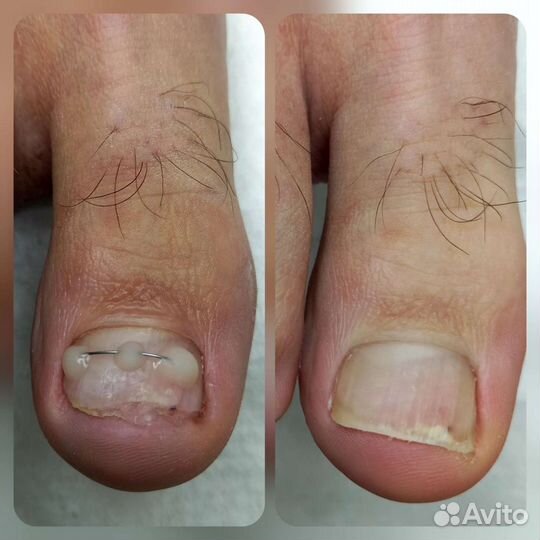 Педикюр подолог