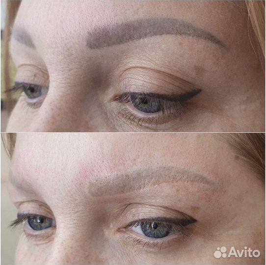 Удаление татуажа и тату лазером