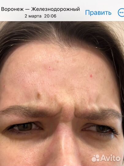 Ботулотоксин, ботокс (Релатокс)