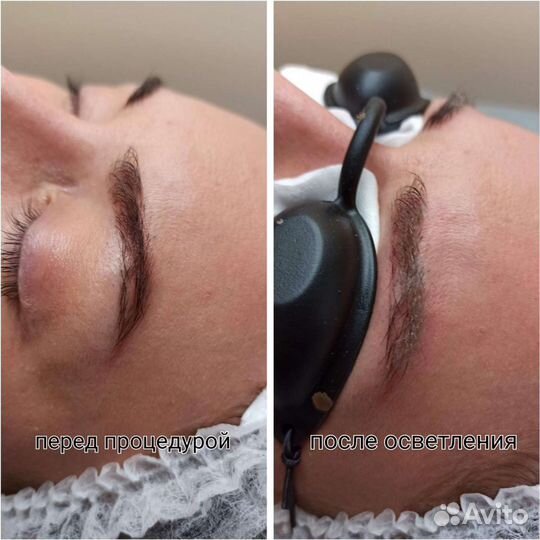 Осветление и удаление татуажа и татуировок